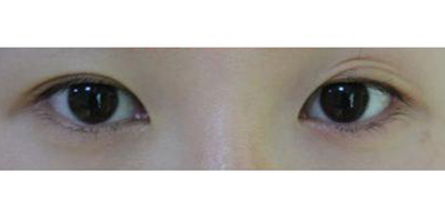 內眥修復術術前