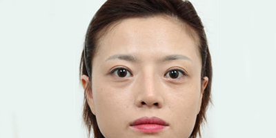 膨體隆鼻術后