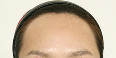 額頭縮小術(shù)前