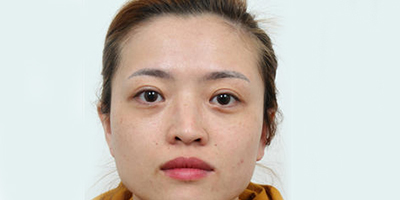 膨體隆鼻術前