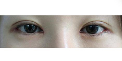內眥修復術術后