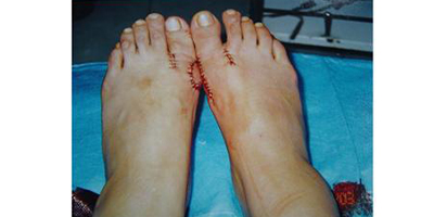 大腳骨矯正術后