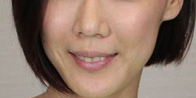 伊膚泉療程套組術后