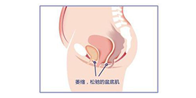 盆底肌修復(fù)術(shù)前