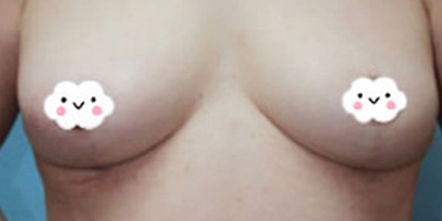 女性乳房縮小術(shù)后