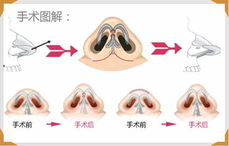 縮鼻頭手術(shù)可以保持多久？縮鼻頭手術(shù)術(shù)后注意事項？