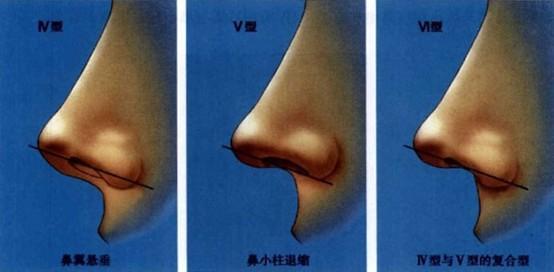 鼻小柱延長術(shù)一般價位多少錢？做鼻小柱延長術(shù)有什么不好的影響嗎？