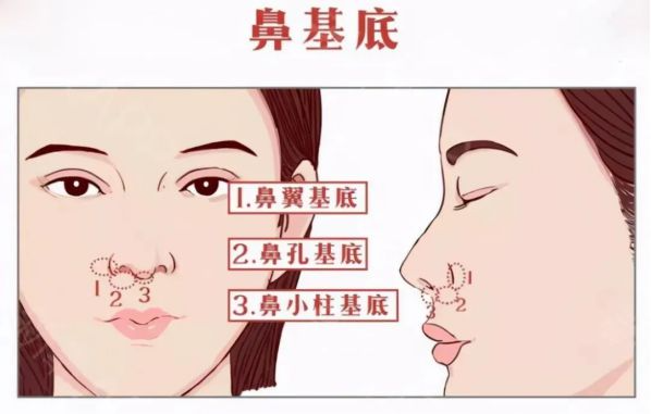 自體脂肪填充鼻基底好不好？鼻基底脂肪填充多久恢復(fù)？