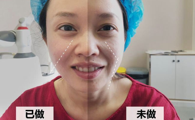 激光溶脂瘦臉的副作用及效果？光纖溶脂瘦臉多久可以見(jiàn)效？