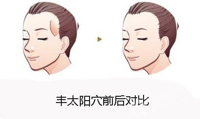 什么是自體脂肪豐太陽穴？用自體脂肪豐太陽穴的效果能維持多久？