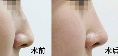 駝峰鼻矯正的方法有哪些？駝峰鼻矯正的方式及適合人群？