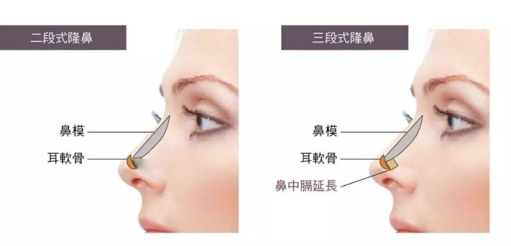 自體軟骨隆鼻的手術(shù)優(yōu)缺點(diǎn)有哪些？肋軟骨填充鼻基底多久能自然？