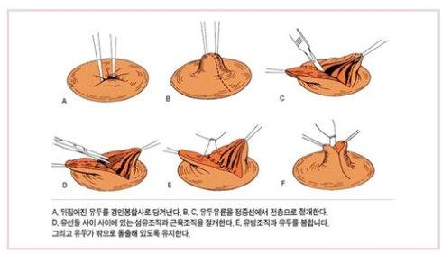 乳頭內(nèi)陷矯正手術(shù)多少錢？乳頭內(nèi)陷矯正手術(shù)多久可以恢復(fù)？
