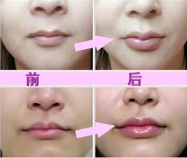 玻尿酸豐唇珠效果怎么樣？玻尿酸豐唇珠多少錢？