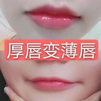 厚唇改薄整形手術(shù)價(jià)格？厚唇改薄多久完全恢復(fù)？