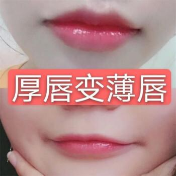 厚唇改薄整形手術(shù)價(jià)格？厚唇改薄多久完全恢復(fù)？