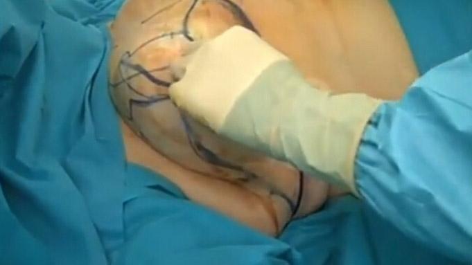 乳房縮小手術(shù)要多少錢？乳房縮小術(shù)是大手術(shù)嗎？