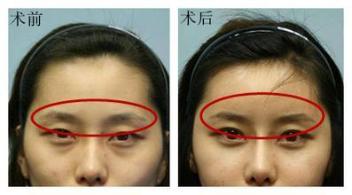 自體脂肪填充眉弓安全嗎？自體脂肪填充是永久的嗎？