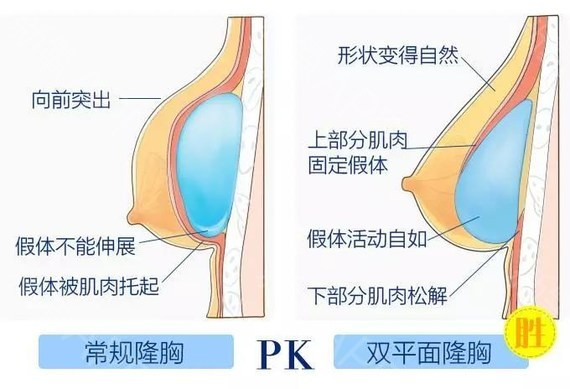 假體隆胸修復(fù)怎么做？做隆胸修復(fù)能維持多久？