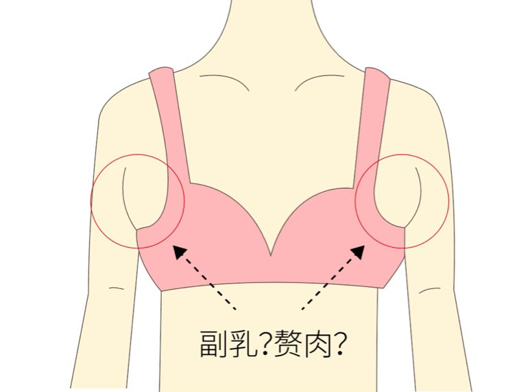 手術(shù)去副乳效果怎么樣？手術(shù)去副乳要注意什么？