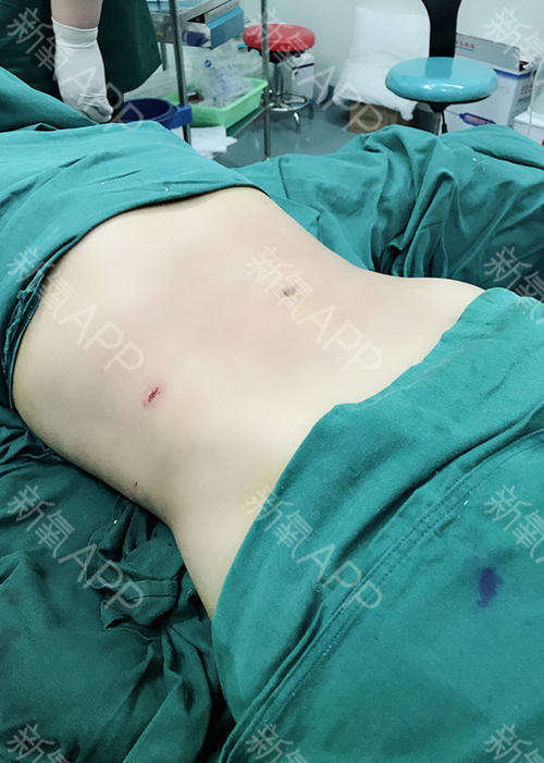 腰腹抽脂效果怎么樣？腰腹抽脂沒有瘦的原因？