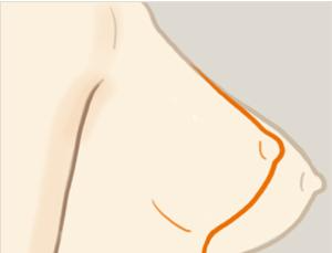乳房下垂矯正手術(shù)風(fēng)險(xiǎn)有多大？ 乳房下垂矯正術(shù)多久能恢復(fù)？