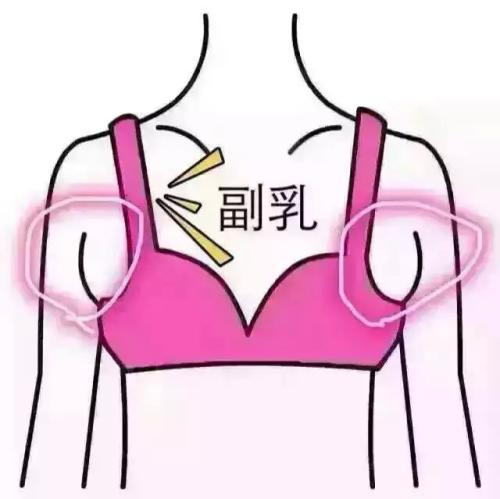 吸脂做副乳要多少錢？吸脂去副乳會反彈嗎？