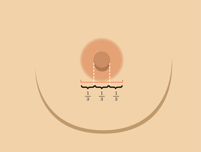 乳暈縮小如何矯正 乳暈縮小術(shù)的注意事項有哪些？