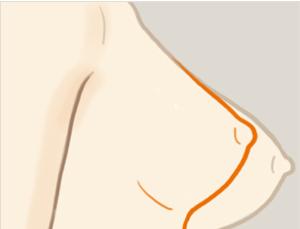 乳房下垂矯正手術(shù)風(fēng)險(xiǎn)有多大？ 乳房下垂矯正術(shù)多久能恢復(fù)？