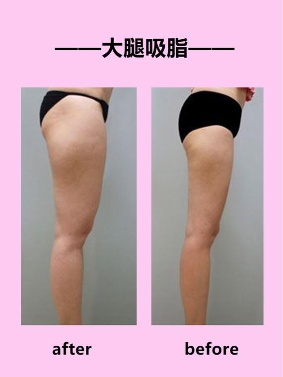 吸脂瘦大腿腫脹期是多久？大腿吸脂有什么后遺癥嗎？