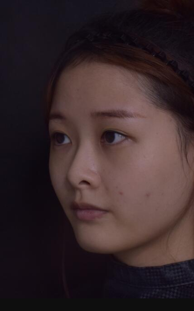 上海藝星醫(yī)療美容醫(yī)院做隆鼻手術前的鼻子