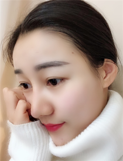 長(zhǎng)春中妍醫(yī)療美容醫(yī)院隆鼻最終效果