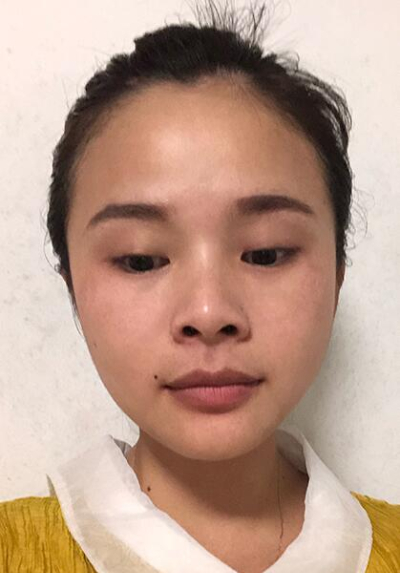 長(zhǎng)春中妍醫(yī)療美容醫(yī)院趙勝友雙眼皮案例效果分享