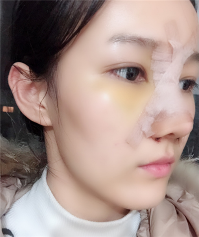 長(zhǎng)春中妍醫(yī)療美容醫(yī)院隆鼻手術(shù)后的效果