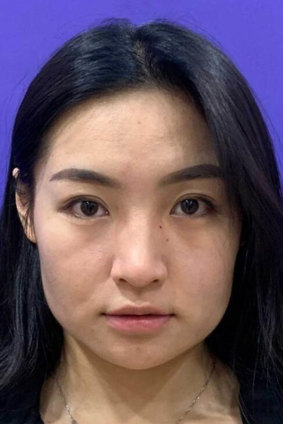 上海美萊醫(yī)療美容門診部做熱瑪吉手術(shù)前臉部的狀態(tài)