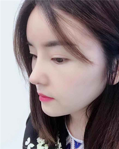 煙臺壹美整形美容醫(yī)院做隆鼻手術(shù)后整個(gè)鼻子的情形