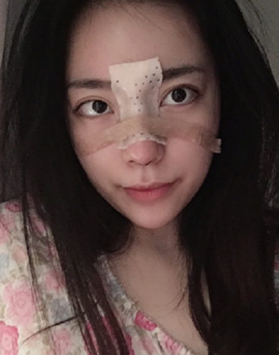 成都漢密爾頓美容醫(yī)院做鼻修復手術(shù)后