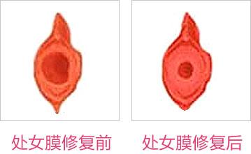 成都東方整形處女膜修復(fù)怎么樣？處女膜修復(fù)術(shù)后如何護(hù)理？