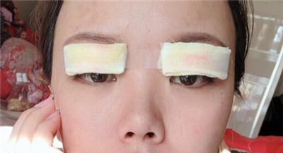 珠海韓妃醫(yī)療美容門診部做雙眼皮手術(shù)后的情形