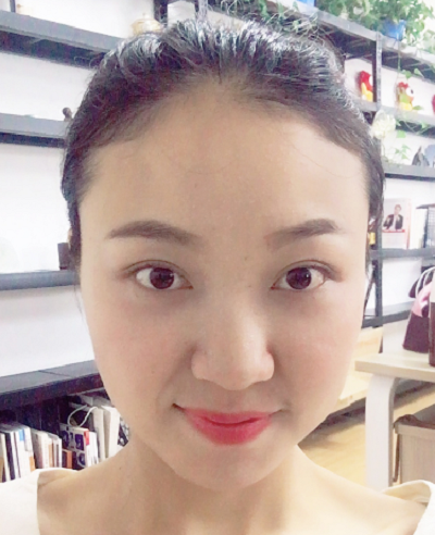 蘇州同濟(jì)醫(yī)院整形美容中心做去眼袋手術(shù)后的第15天