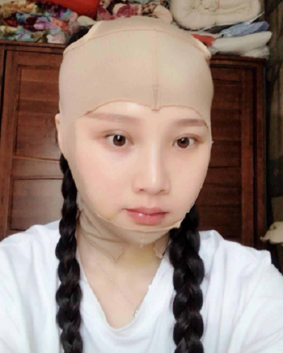 鄭州麗天整形美容醫(yī)院做面部吸脂手術后的情形