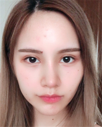 深圳弘美醫(yī)療美容門診部做眼綜合手術(shù)后半個(gè)月