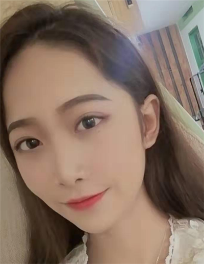 蘇州美貝爾美容醫(yī)院做面部吸脂手術(shù)后日?；謴?fù)效果