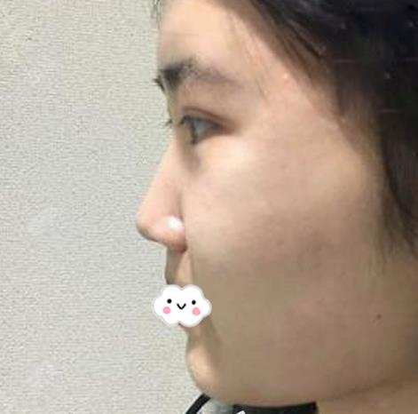 假體隆鼻假嗎？假體隆鼻三個月效果分享