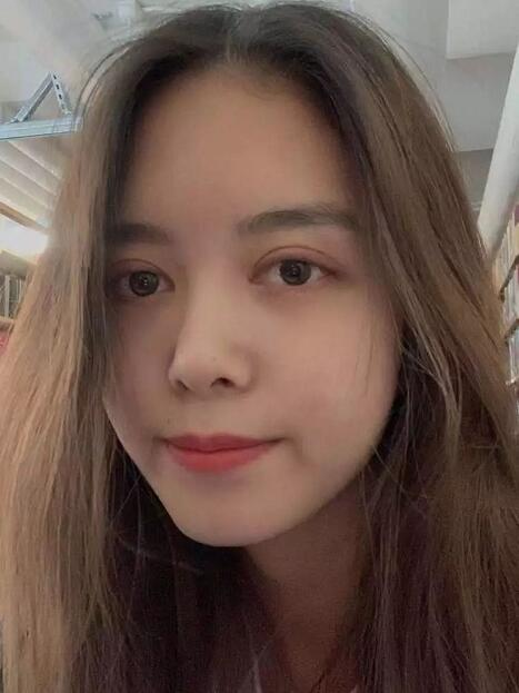 做雙眼皮案例，鄭州壹加壹王洛生全切雙眼皮案例圖片