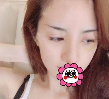 宜昌奧萊整形楊群申膨體隆鼻案例術后十天效果