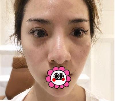 宜昌奧萊整形楊群申膨體隆鼻案例術前效果