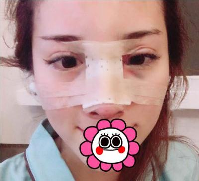 宜昌奧萊整形楊群申膨體隆鼻案例術后兩天效果
