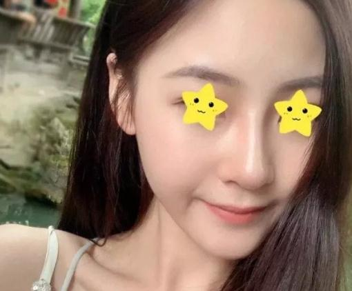 做綜合鼻，上海首爾麗格安建榮鼻綜合真人案例照片