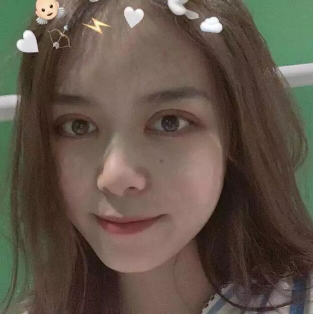 鄭州壹加壹王洛生全切雙眼皮案例術(shù)后一個月